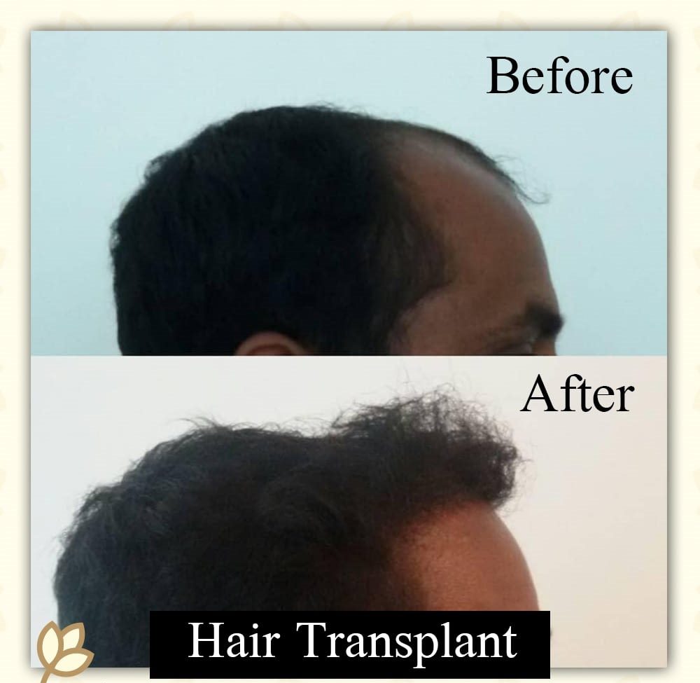 Hair Transplant Results -