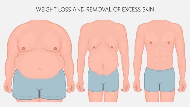 Tummy Tuck Surgery In Kolkata - Cost, Procedure & Recovery