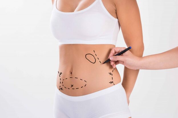 Areas of the Body Liposuction Can Improve