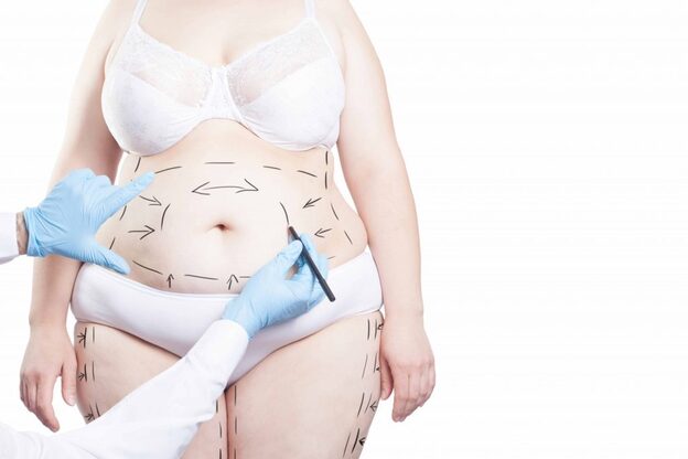 Abdominoplasty (Tummy Tuck) - Body Procedure at best price in Lucknow