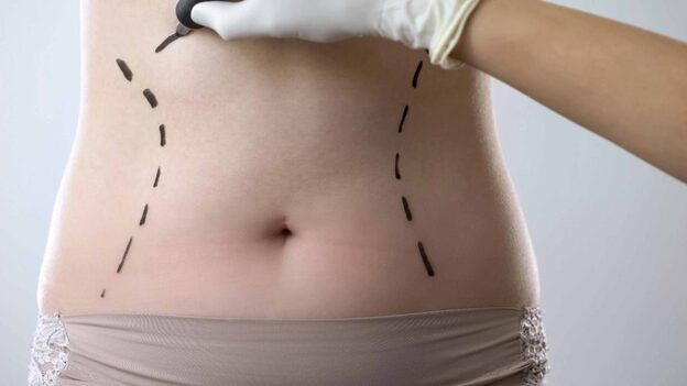 Tummy Tuck Surgery In Kolkata - Cost, Procedure & Recovery