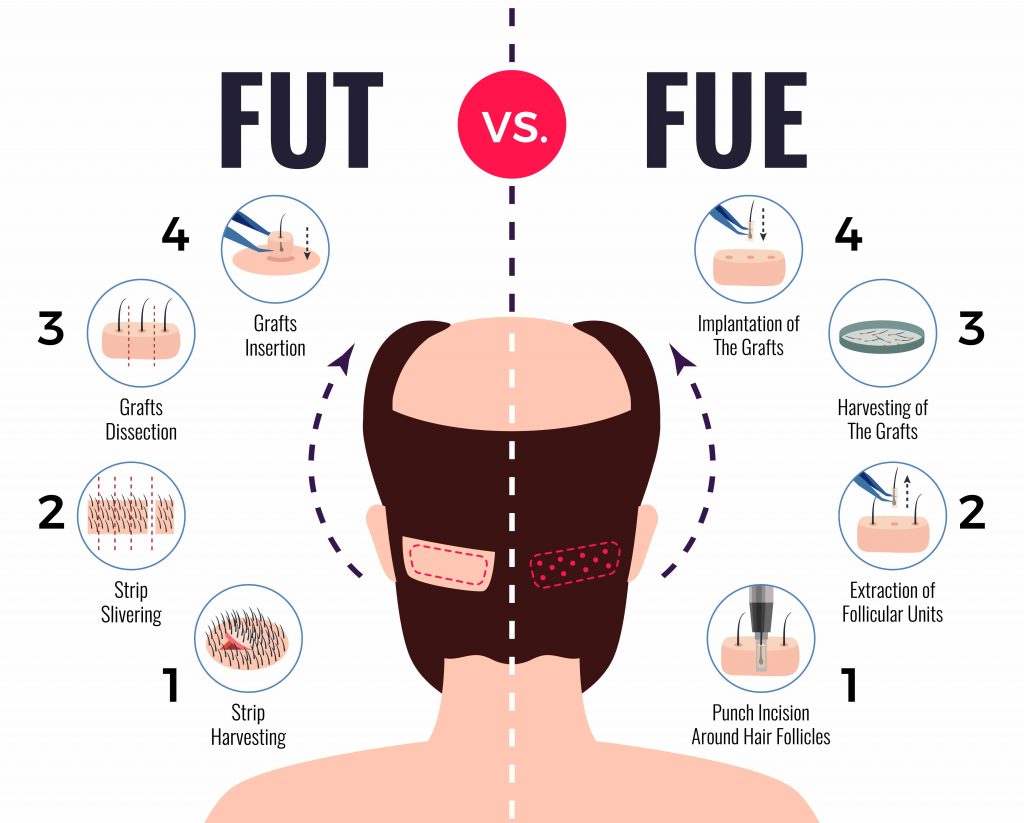 Hair Transplant: Procedure, Types, Candidate, Cost, Side Effects