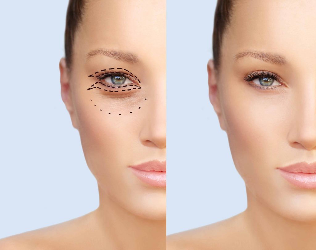 The Vision of Clarity: Ask the Surgeon Before Eyelid Surgery