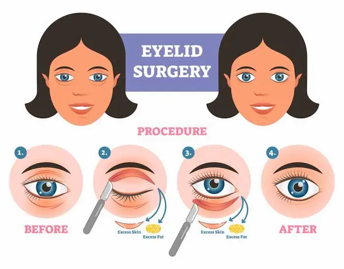 The Vision of Clarity: Ask the Surgeon Before Eyelid Surgery