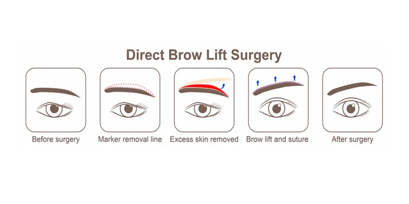 Surprising Facts Of Brow Lift