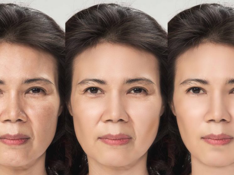 Demystifying the Facelift Myths