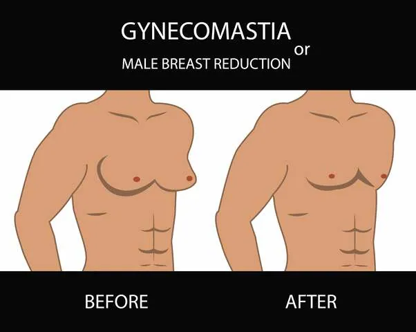 A Deep Dive into Gynecomastia Surgery Recovery and Outcomes