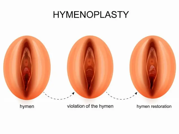 How hymenoplasty can help regaining Virginity