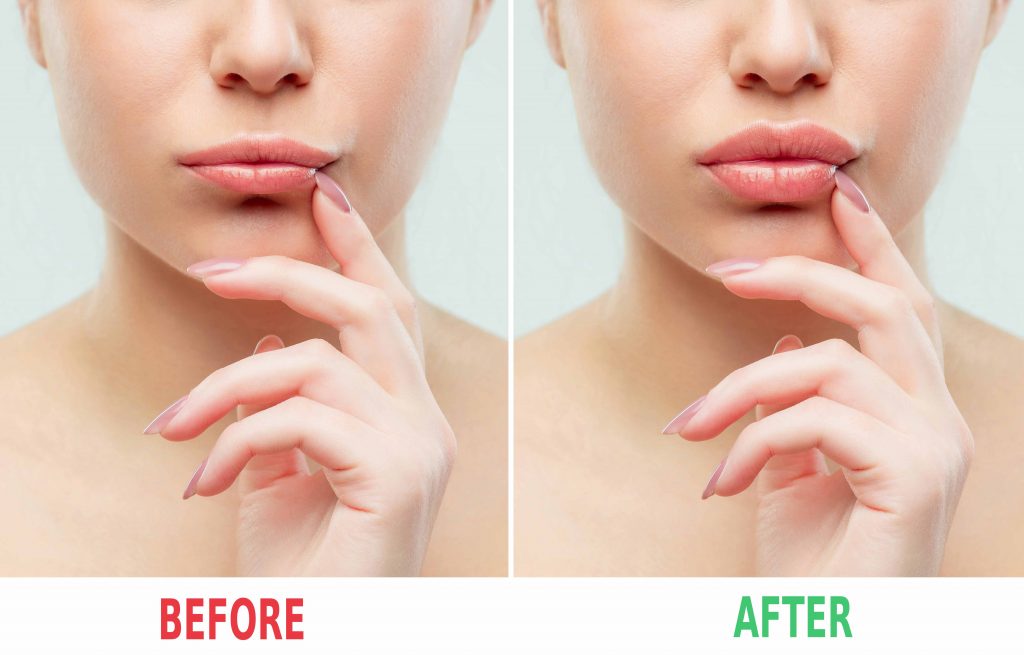 Debunking the Myths of Lip Augmentation through Fillers