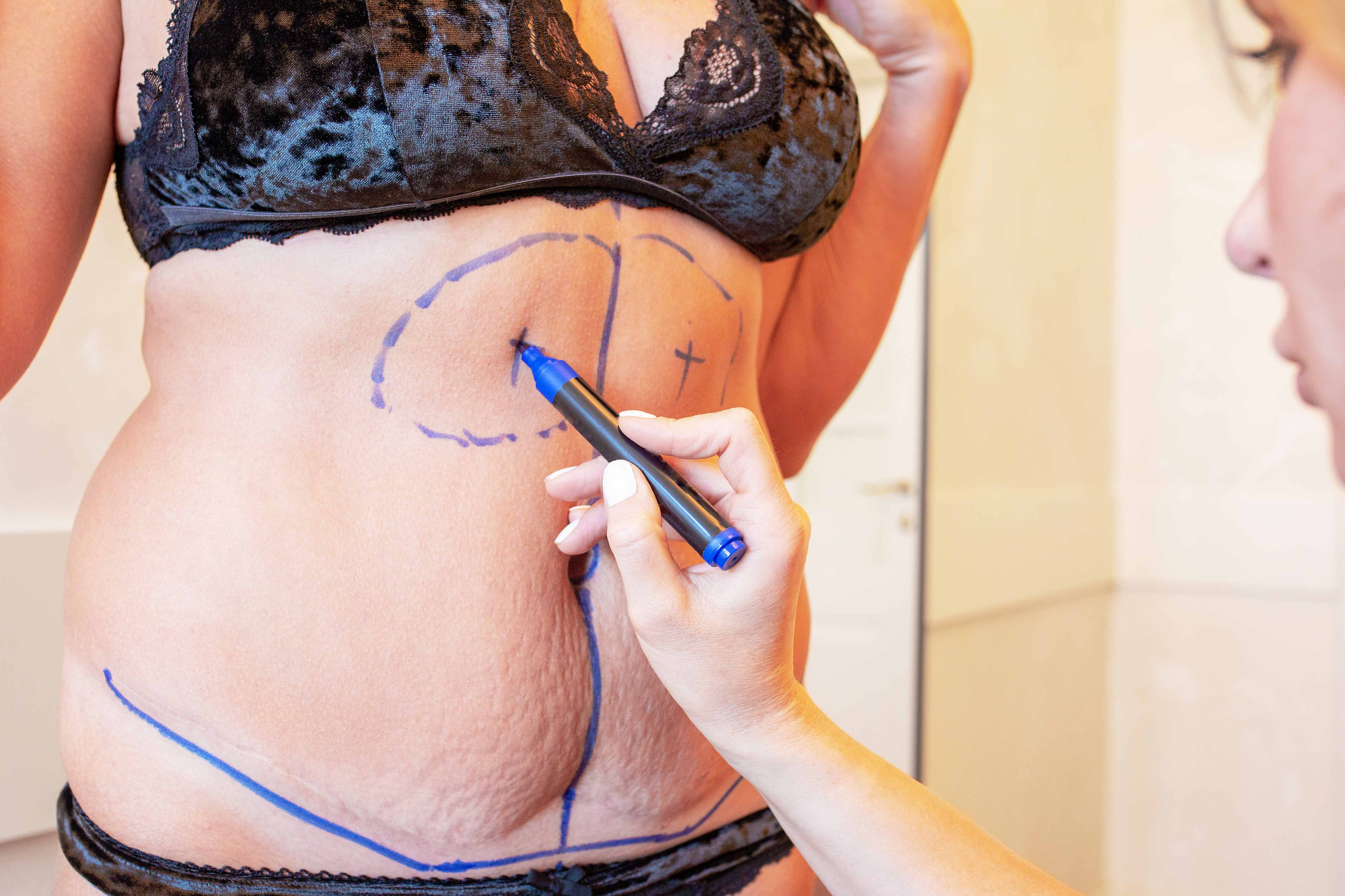 Liposuction: Debunking the common myths