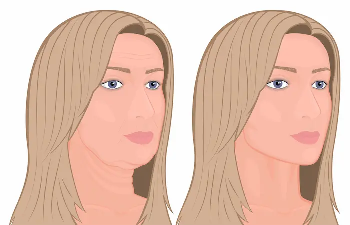 Neck lift or lower Rhytidectomy