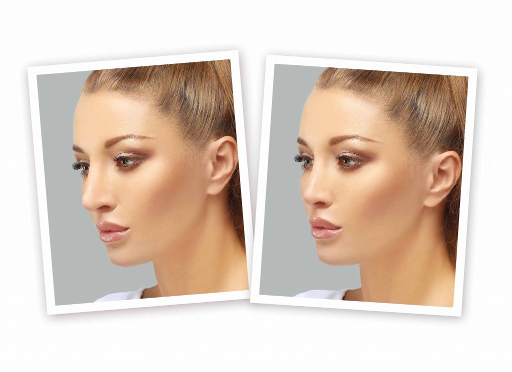 Beyond Expectations: The Art and Science of Revision Rhinoplasty