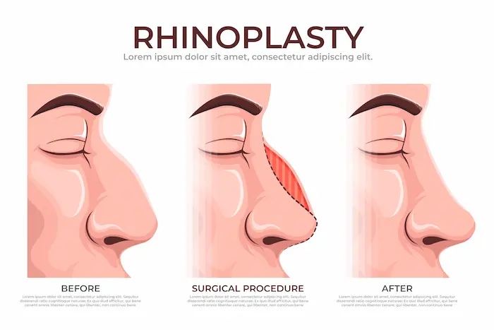 Specific Reasons to Opt for Rhinoplasty