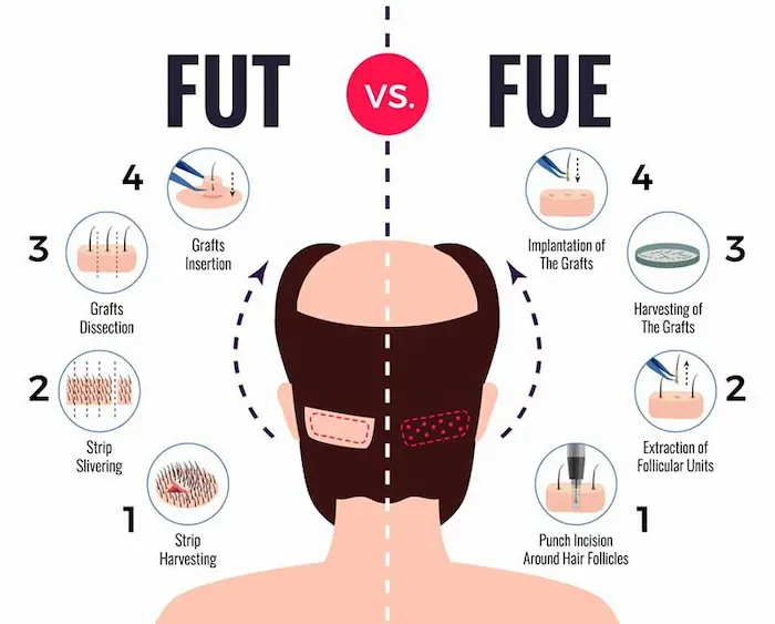 Comparative Analysis of FUE and FUT for Hair Restoration