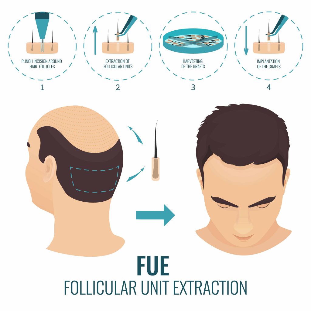 FUE Hair Transplant: The Revolutionary Solution for Hair Restoration