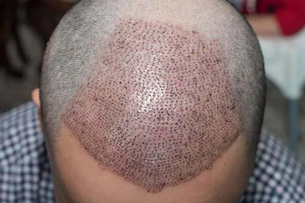 Post-Operative Instructions for Hair transplant